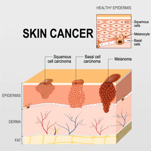 Skin Cancer