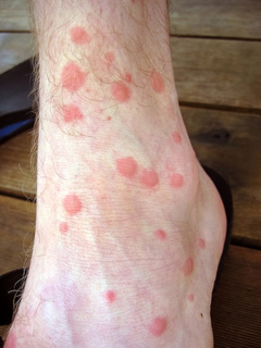 Mosquito Bites